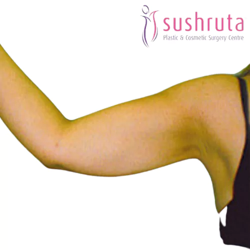 After Arms Liposuction in Coimbatore