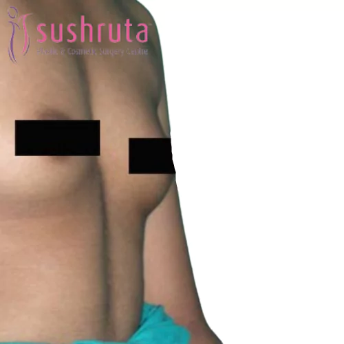 Before Breast Implant in Coimbatore