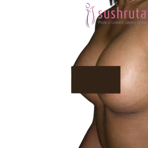 After Breast Implant in Coimbatore