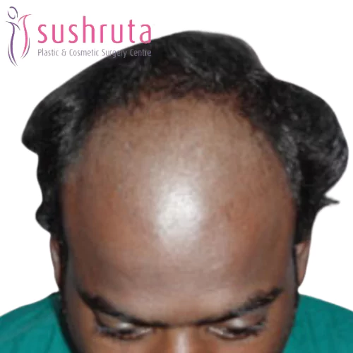 Before Hair Transplant Treatment in Coimbatore