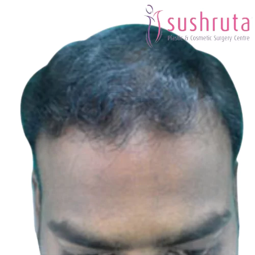 After Hair Transplant Treatment in Coimbatore