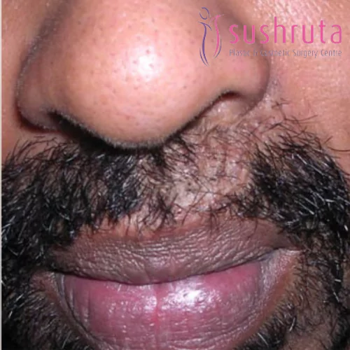 After Hair & Laser Transplant Treatment in Coimbatore