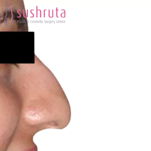 Before NoseJob Treatment in Coimbatore