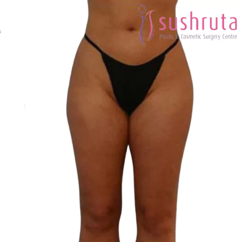 After Thigh Liposuction in Coimbatore