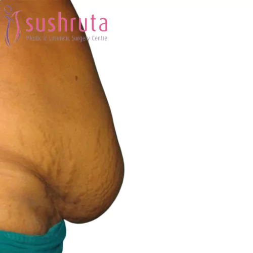 Before Abdominoplasty Cosmetic Surgery in Coimbatore