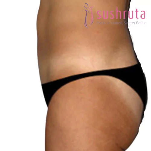 After Tummy Tuck Plastic Surgery in Coimbatore