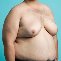 Pseudogynecomastia treatment in Singanallur, Coimbatore uses liposuction to remove fat and shape the chest