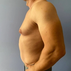 Personalized adult-onset gynecomastia surgery in Singanallur, Coimbatore restores a firm, natural chest shape