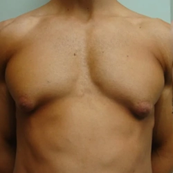 Expert true gynecomastia treatment in Gandhipuram, Coimbatore to restore a natural and masculine chest shape