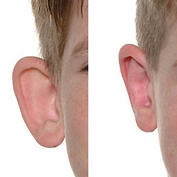 Correct uneven earlobes with safe ear correction surgery Near Trichy Road for natural symmetry.