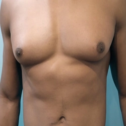Effective pseudogynecomastia treatment in Gandhipuram, Coimbatore with liposuction for a firm, balanced chest