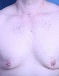 Expert surgeons provide unilateral and bilateral gynecomastia reduction surgery at Sushruta Centre, Peelamedu.
