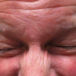 Close-up of man with tightly shut eyes showing blepharospasm treated using botulinum therapy
