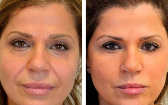 Botox Injection Treatment For Wrinkle Reduction in Gandhipuram A cosmetic surgeon performs Botox injection treatment for wrinkle reduction and smoother skin appearance.