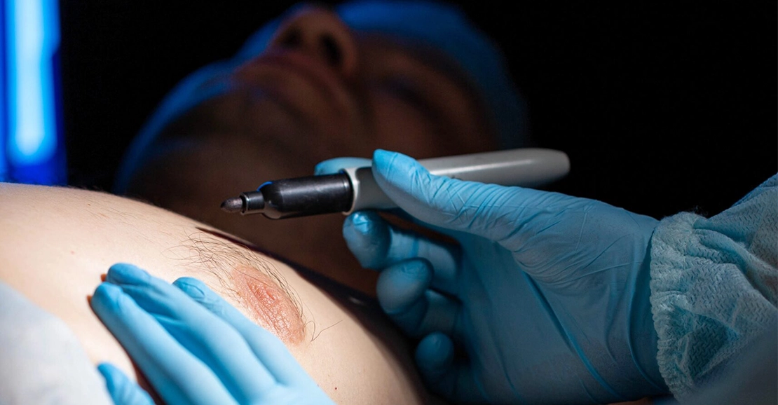 Expert  plastic surgeon performing male chest reduction in Peelamedu, Coimbatore for gynecomastia treatment.