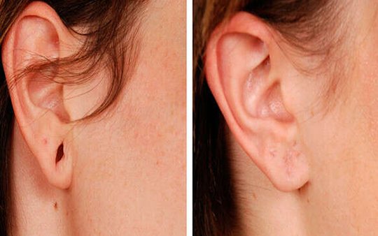 Ear Lobe Repair for Torn or Stretched Earlobes, Ukkadam Effective ear lobe repair for torn or stretched lobes by cosmetic surgeons near Ukkadam