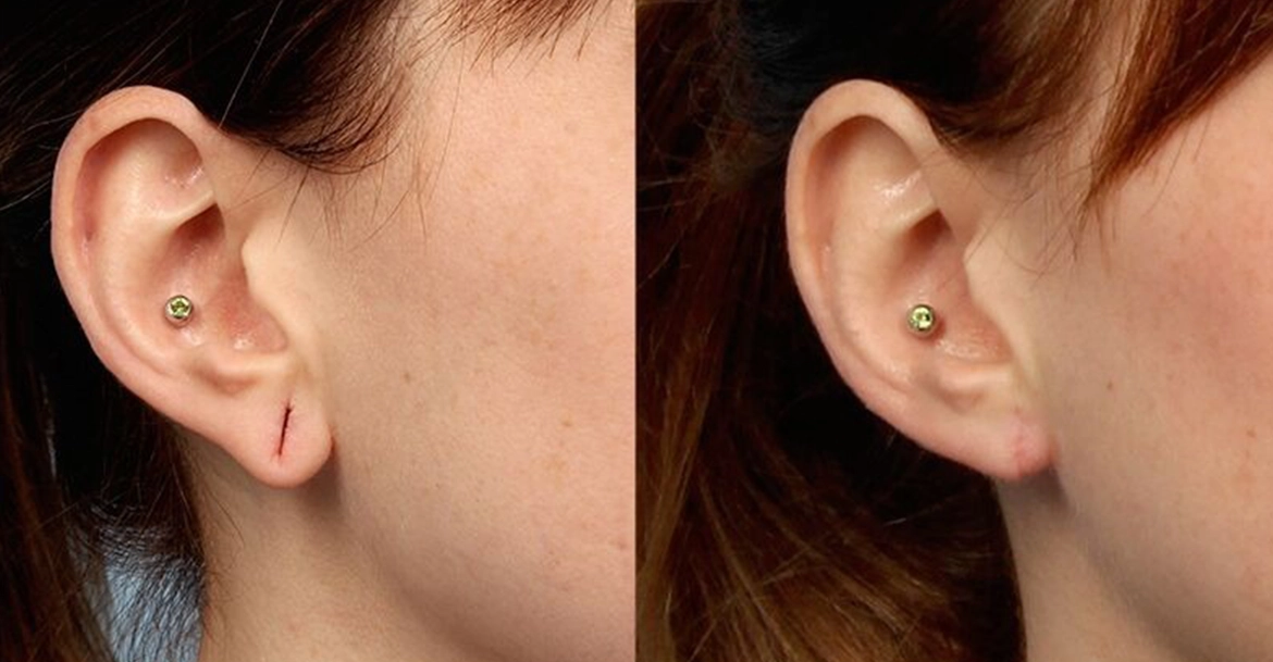 Professional ear hole stitching near Town Hall, Coimbatore for secure healing and natural appearance.