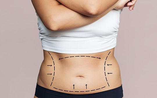 Tummy Tuck & Abdominoplasty Surgery Clinic Near Ukkadam Reshape your abdomen with expert tummy tuck and abdominoplasty surgery near Ukkadam