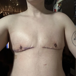 Safe drug-induced gynecomastia surgery in Singanallur to removes extra tissue with minimal downtime