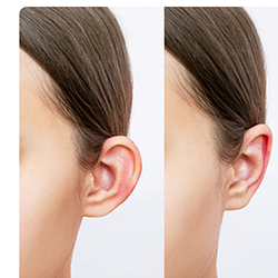 Earlobe asymmetry correction of uneven earlobes for balanced look near Gandhipuram Coimbatore