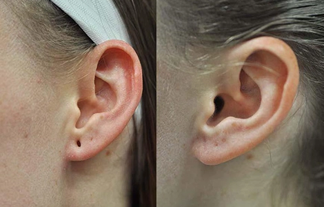 Restore confidence and ear shape with expert earlobe correction near Ukkadam, Coimbatore.