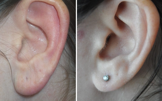 Ear Hole Stitching & Earlobe Repair Surgery Near Gandhipuram We offer earhole stitching & earlobe repair surgery near Gandhipuram to restore torn or stretched lobes.