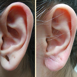Safe and effective earlobe reduction surgery for large or stretched lobes near Kalapatti, Coimbatore