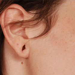 Earlobe reduction surgery treatment in Peelamedu, Coimbatore for reshaping and smaller ear size.