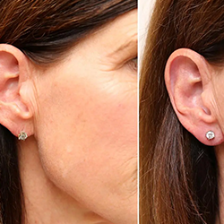 Get Professional Earlobe Correction for Stretched or Elongated Lobes Near Ramanathapuram