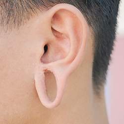 Get earlobe reduction surgery near Saibaba Colony for a smaller, balanced,  natural-looking result.
