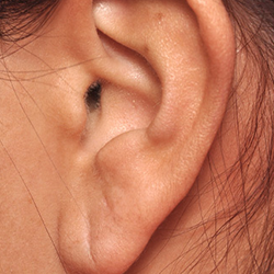 Get Professional Earlobe Correction for Stretched or Elongated Lobes Near Singanallur, Coimbatore