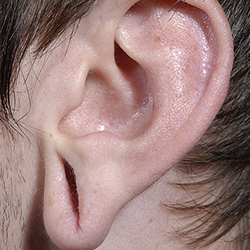 Affordable Non-surgical torn ear hole stitching and repair treatment near Gandhipuram Coimbatore