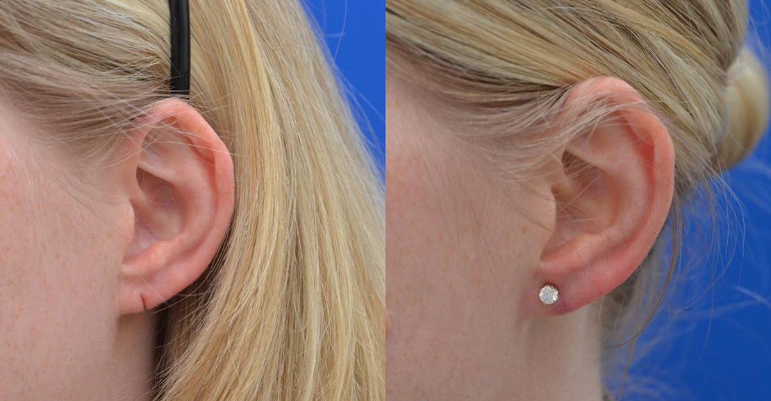 Non-Surgical Earlobe Closing Treatment Available near Gandhipuram for Torn or Stretched Ears