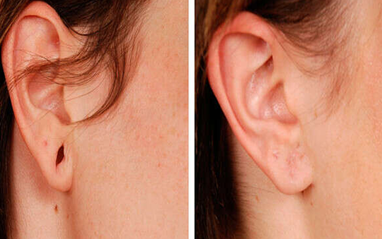 Ear Hole Stitching & Earlobe Repair Surgery Near Town Hall Experienced surgeons provide earlobe correction, repair, and cosmetic care Near Town Hall, Coimbatore