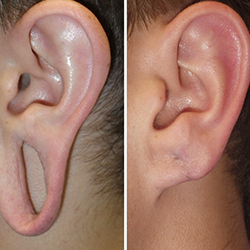 Expert earlobe repair near Saibaba Colony to fix stretching caused by spacers and restore shape.