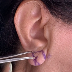 Safe and effective earlobe reduction surgery for large or stretched lobes Near Ondipudur, Coimbatore