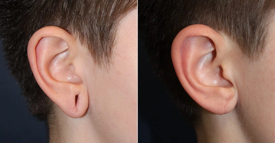 Safe and Affordable Earlobe Repair & Stitching for Stretched Ears near R.S. Puram, Coimbatore