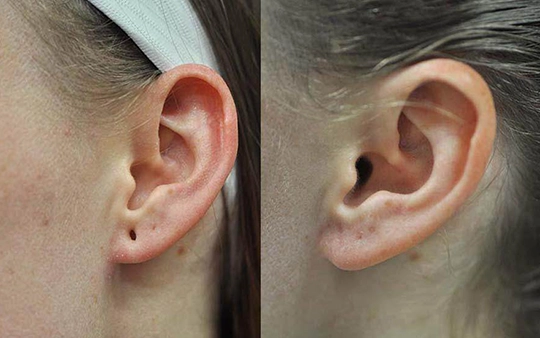 Earlobe Repair Treatment in Udayampalayam, Coimbatore Restore torn or stretched earlobes with expert earlobe repair in Udayampalayam, Coimbatore for a natural look.