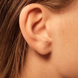 Get Professional Earlobe Correction for Stretched or Elongated Lobes near R.S. Puram, Coimbatore