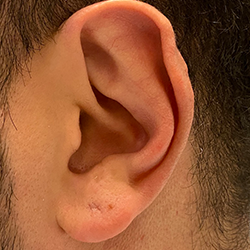 Earlobe reshaping treatment near Avinashi Road, Coimbatore for smooth, balanced, and natural results.
