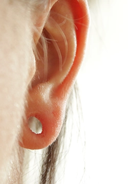 Earlobe reshaping near Town Hall, Coimbatore to restore natural ear shape and improve overall facial balance.