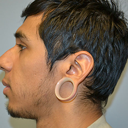 Professional treatment for repairing gauged or stretched earlobes near Trichy Road, Coimbatore