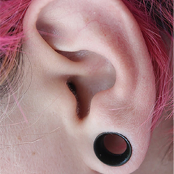 Surgery for stretched earlobe spacer hole to restore shape near Gandhipuram Coimbatore.