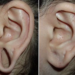 Earlobe asymmetry correction of uneven earlobes for balanced look Near Avinashi Road