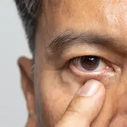 Botox in Ondipudur to relieve eyelid spasms and improve clear vision with lasting comfort