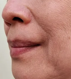 Close-up of facial wrinkles treated with Botox to smooth glabellar and forehead lines effectively
