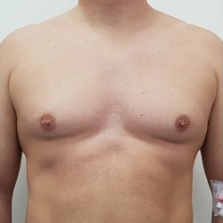 Safe pubertal gynecomastia surgery in Gandhipuram, Coimbatore to restore a natural, flat, masculine chest