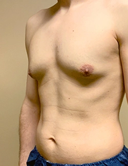 Specialized surgeons offer pubertal gynecomastia male breast reduction at Sushruta Centre, Peelamedu.