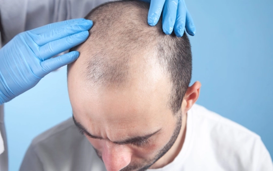 Hair Transplant & Laser Hair Removal Treatment Near Gandhipuram Get top Hair Transplant & Laser Hair Removal Treatment near Gandhipuram for smooth, natural results.