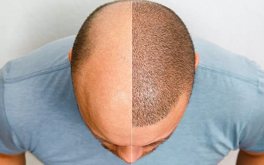 Hair Transplant & Laser Hair Removal Treatment Near Kalapatti Get top Hair Transplant & Laser Hair Removal Treatment near Kalapatti for smooth, natural results.